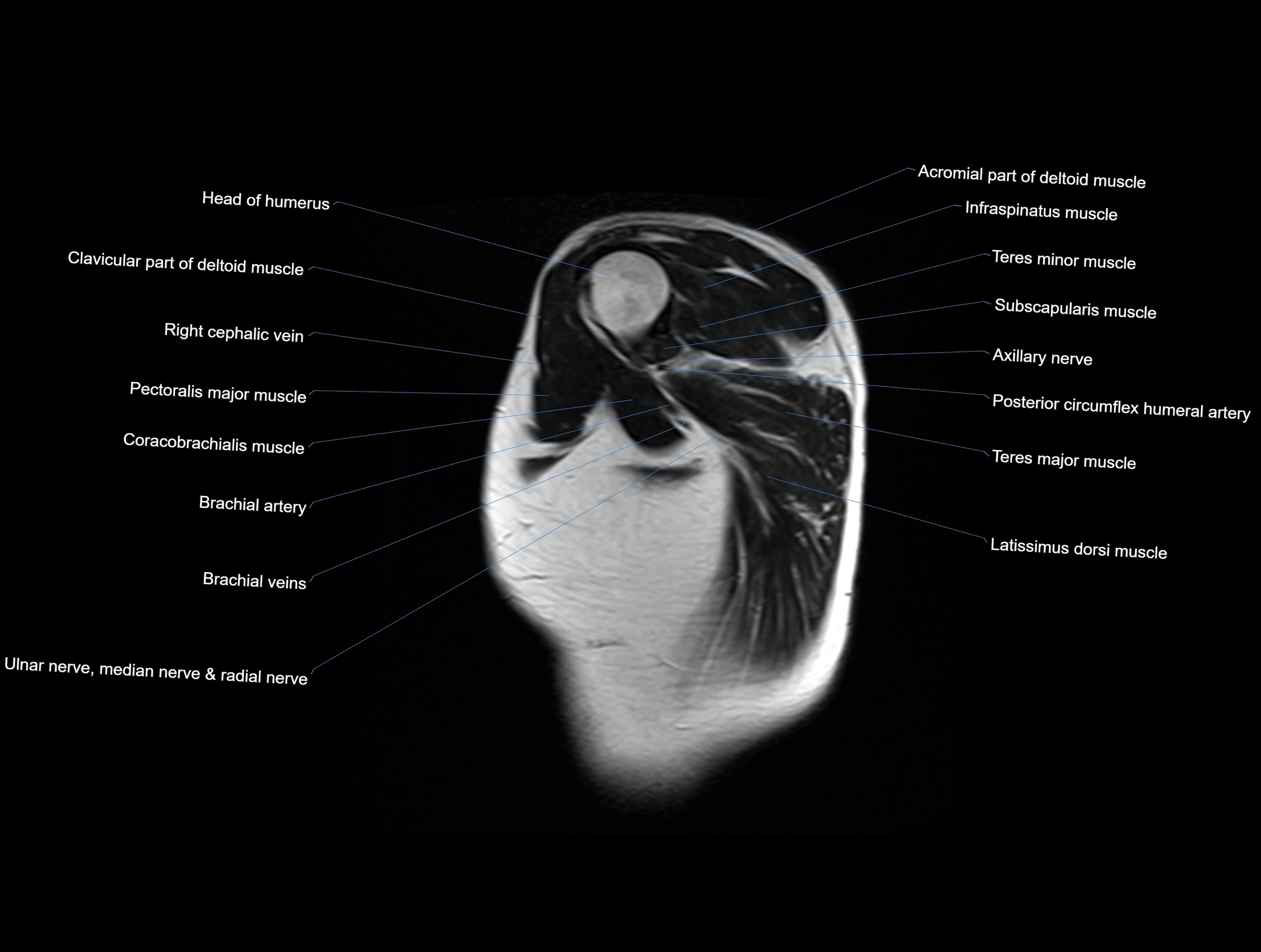 MRI chest (thorax) coronal  cross sectional anatomy 3T radiology  image-img-00001-00001.webp